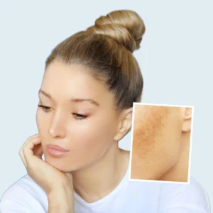 Peeling químico, clínica estética high care beauty en Antofagasta.