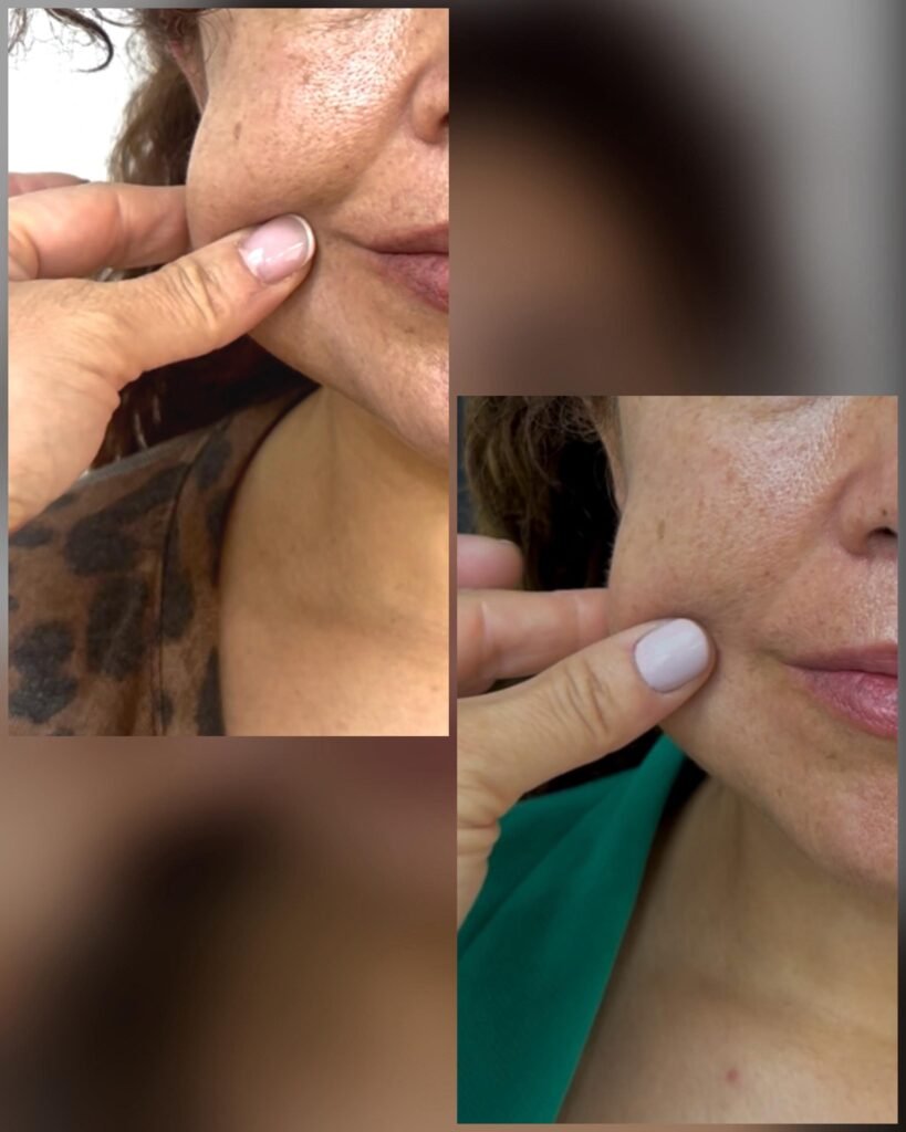 Tratamiento de acido hialuronico en mujer adulta, clínica estética high care beauty en Antofagasta.