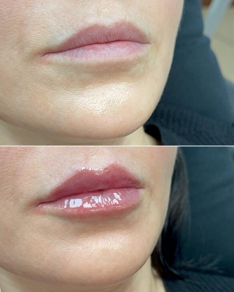 Antes y después de labios con acido hialuronato, clínica estética high care beauty en Antofagasta.