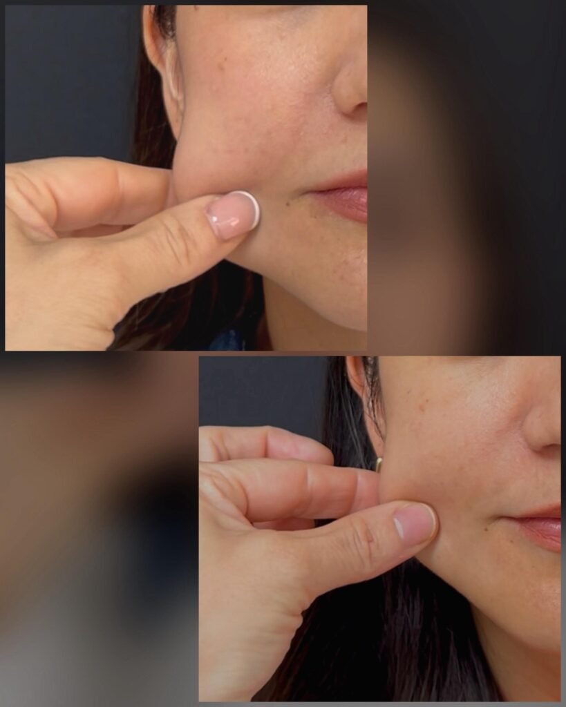 Tratamiento de acido hialuronico en mujer joven, clínica estética high care beauty en Antofagasta.