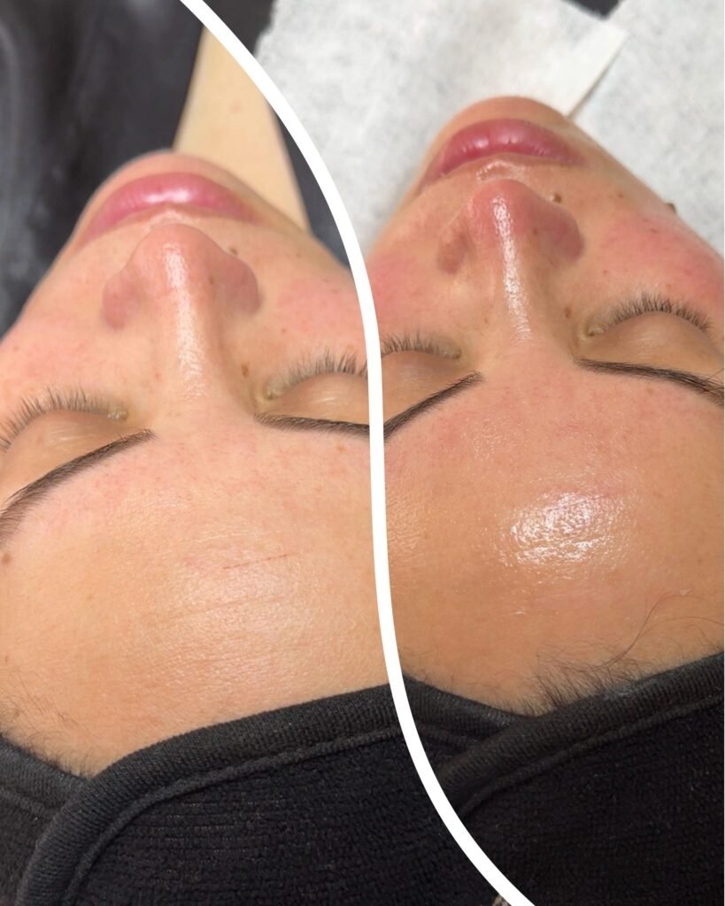 Tratamiento para lineas de expresion con acido hialuronico, clínica estética high care beauty en Antofagasta.