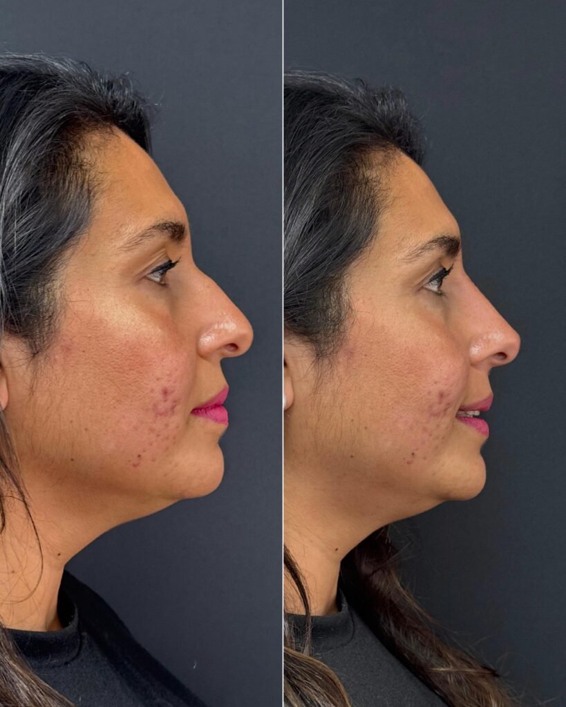 Armonización facial con acido hialuronico, clínica estética high care beauty en Antofagasta.